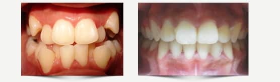 ortodoncia antes y despues