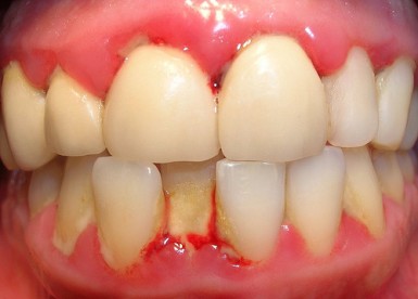 Acumulación de sarro por malposición dental.