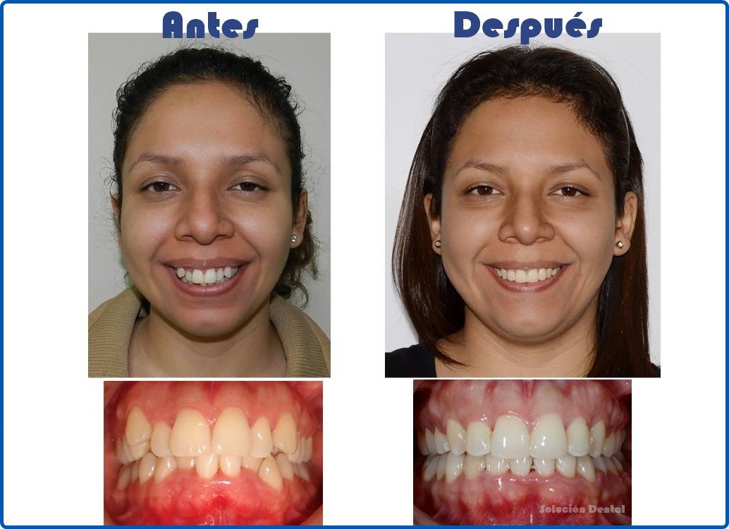 Fotos antes - después | Solución Dental