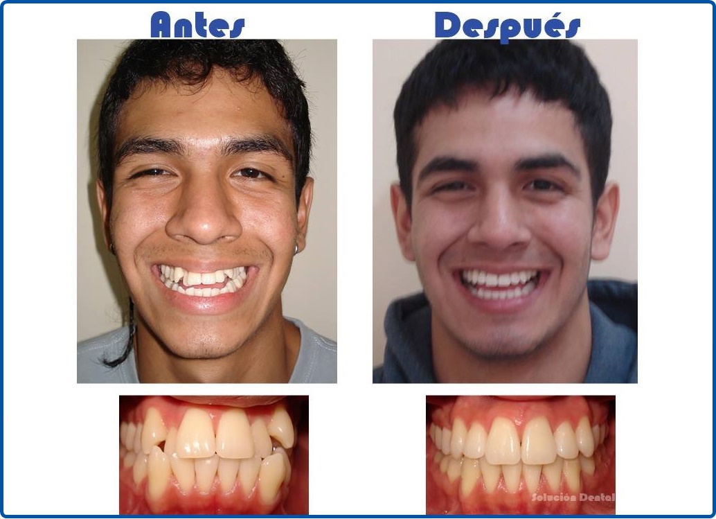 Fotos antes - después | Solución Dental