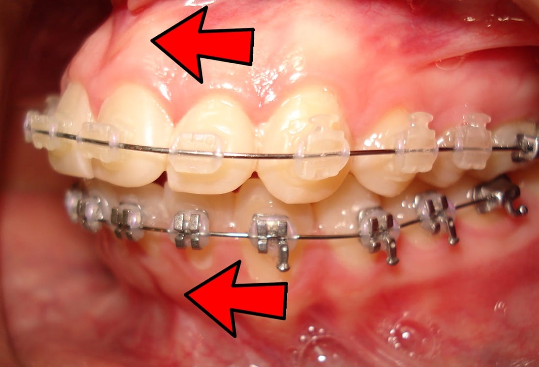 Extracciones en ortodoncia ¿Cuándo son necesarias? Solución Dental