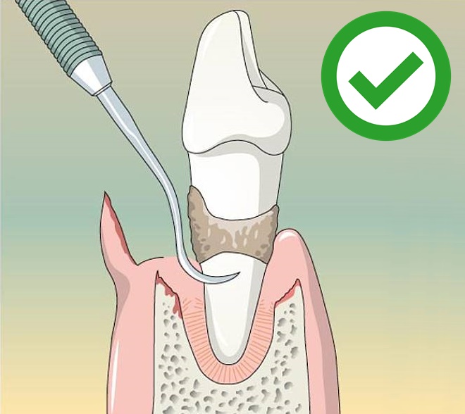 Curetaje Dental ¿Qué es y cuándo se realiza? Solución Dental